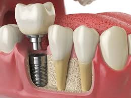 Dental Implants - Best Dental Solutions in Jaipur | Dental World Jaipur