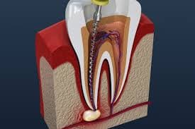 Root Canal Therapy - Best Dental Solutions in Jaipur | Dental World Jaipur