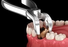 Tooth Extractions - Best Dental Solutions in Jaipur | Dental World Jaipur